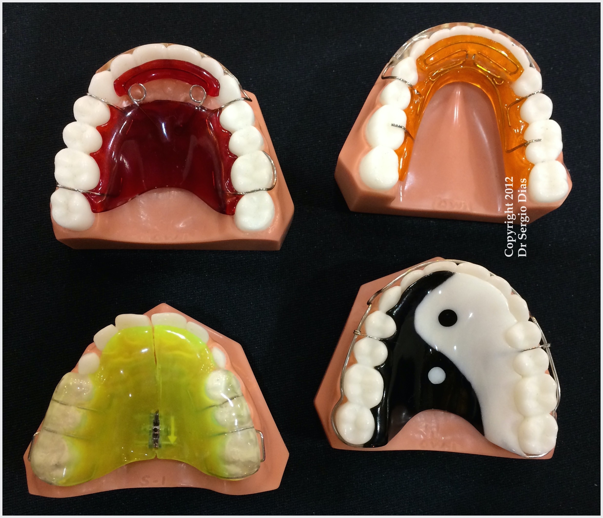 Dentes Muito Ruins Antes E Depois Do Aparelho Dente Mole O Que 